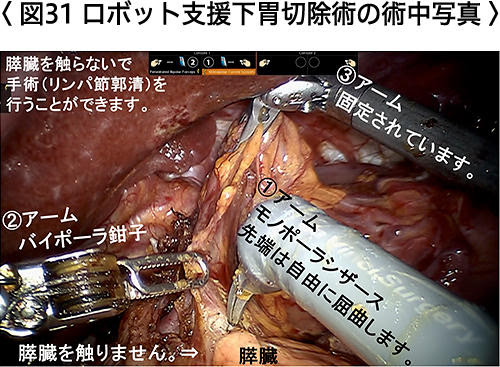 さらに詳しい胃がんのお話 胃がんの診断から治療 手術 化学療法 まで 近畿大学医学部 外科学教室