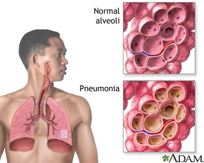 Nursing Care Plan for Pneumonia