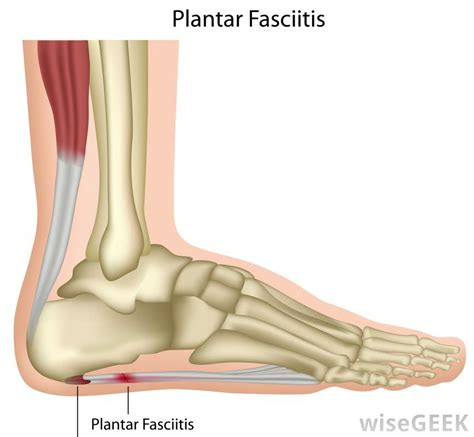 Webmd shows you what you can do to feel better. How do I Treat Foot Arch Pain? (with pictures)