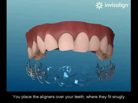 Invisalign technology