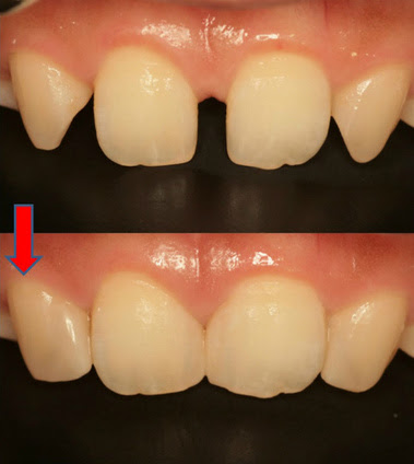 すきっ歯 空隙歯列 が綺麗に治った Ee Dental Blog
