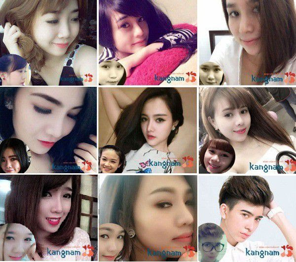 Các khách hàng nói gì về nâng mũi tại Bệnh viện thẩm mỹ Kangnam?