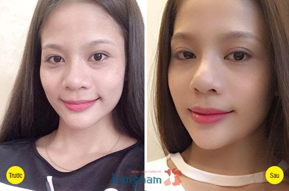 Bị bọng mắt lâu năm có chữa được không?44