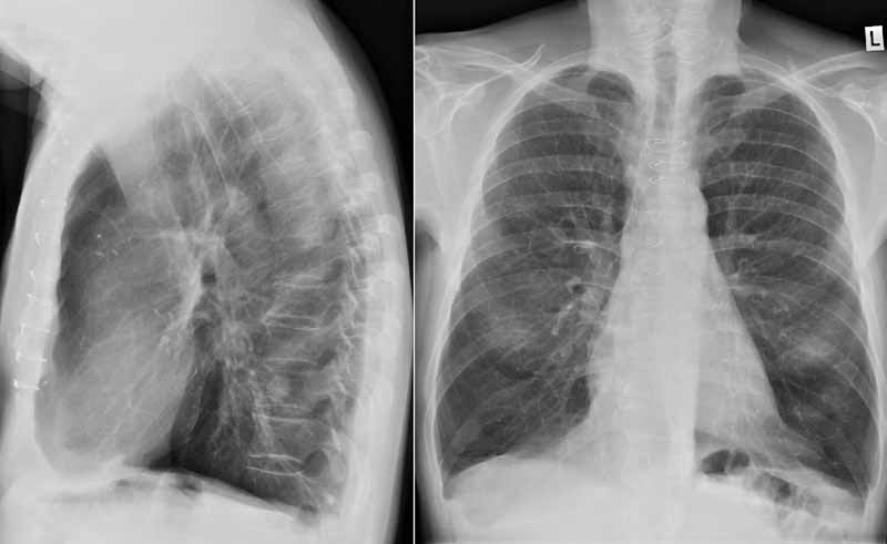 Radiologie Der Lunge Lehrsammlung Copd