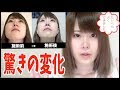 【ベストコレクション】 ヒアルロン酸 入れ過ぎ 121803-ヒアルロン酸 入れ過ぎ