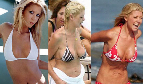 Tara Reid - Operasi Plastik Tara Reid - Operasi Plastik