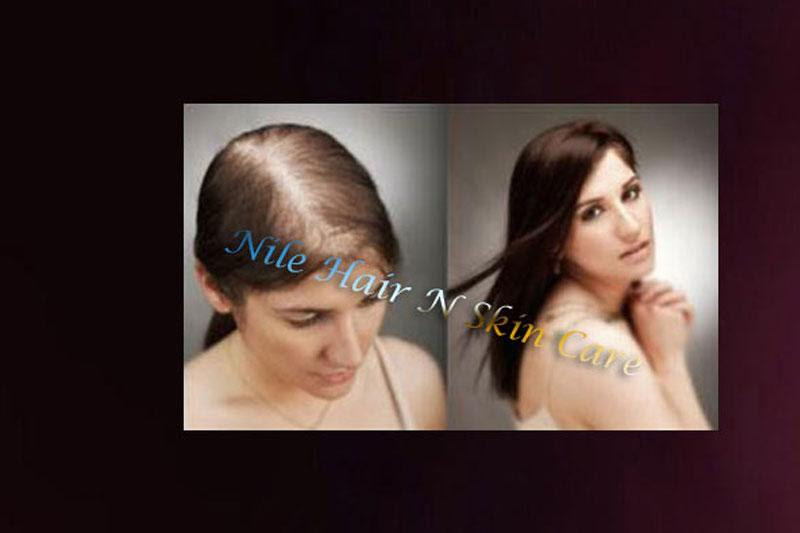 Hair Transplant In Bangalore Hair Transplant Cost In Bangalore