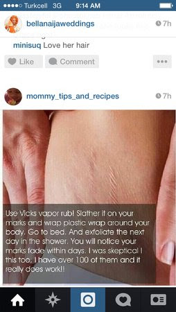 Vicks Vapor Rub And Plastic Wrap For Stretch Marks Babycenter