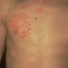 Skin Treatments By Dermatologist - Dr. Pimple Popper Faces off Against the "Blackhead Mask : Skin discoloration, defined by healthline as areas of skin with irregular pigmentation, is a relatively common complaint.
