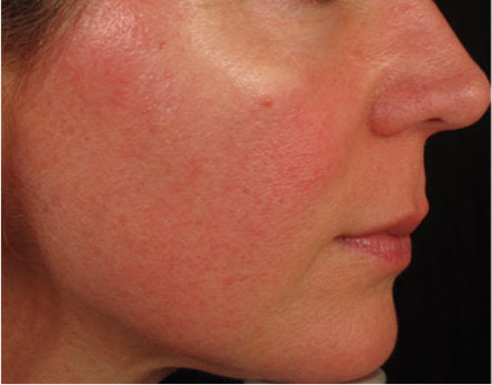 for face on redness & Dermatology  Capillaries   Facial Redness One Broken Clinic