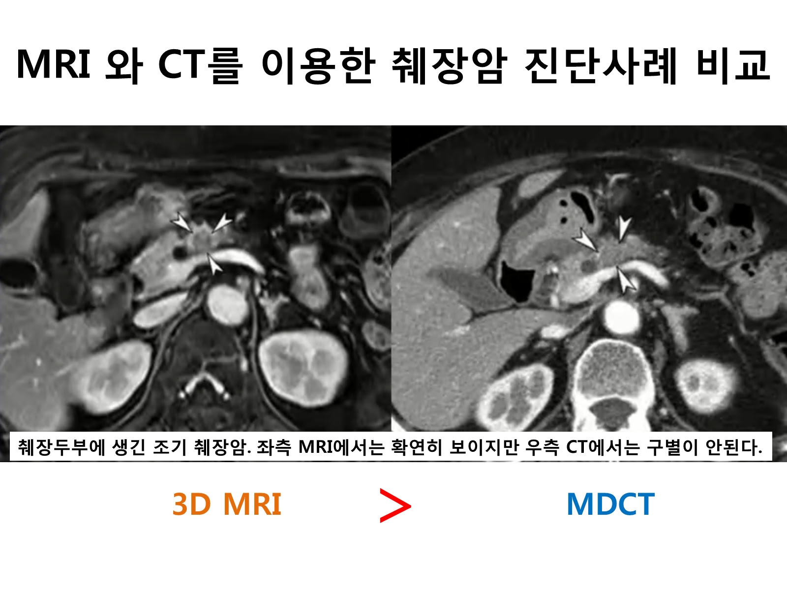 ì¡°ê¸°ì§ë¨ì´ ì´ë ¤ì´ ì·ì¥ì