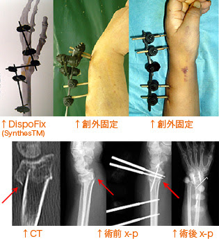 整形外科 手首の骨折といわれたら クロス病院