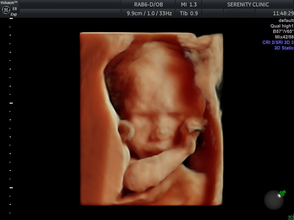 3d 4d Ultrasound Doppler Color