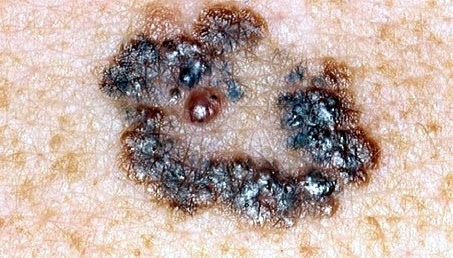 melanoma_malignum.jpg