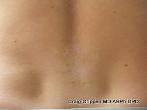 Laser Tattoo Removal in Kelowna from Dr. Crippen at DermMedica Clinic