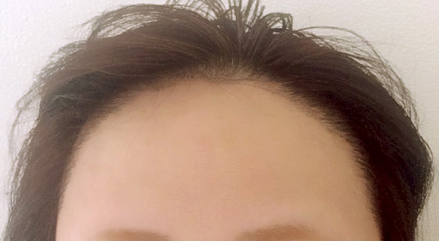 女性体験者をみる Global Hair 韓国で多くの日本人が大満足している激安自毛植毛ご提供致します