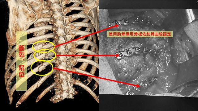 九旬翁肋骨骨折疼痛折磨肋骨骨板固定術助早復元 民生好報