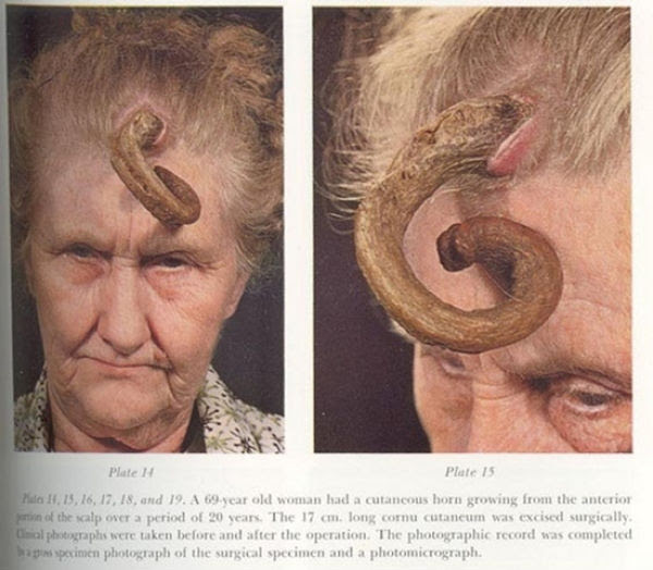 People Who Grow Real Horns (9 pics)