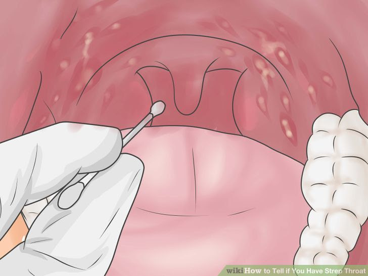 Tell if You Have Strep Throat Step 23 Version 2.jpg