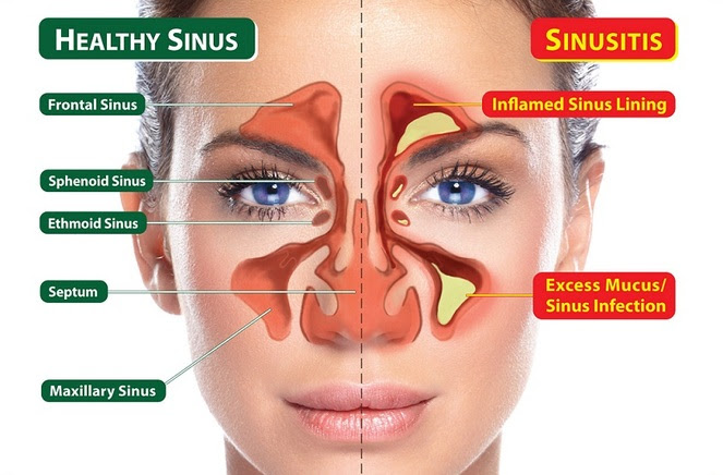 sinus signs and symptoms one aspect face