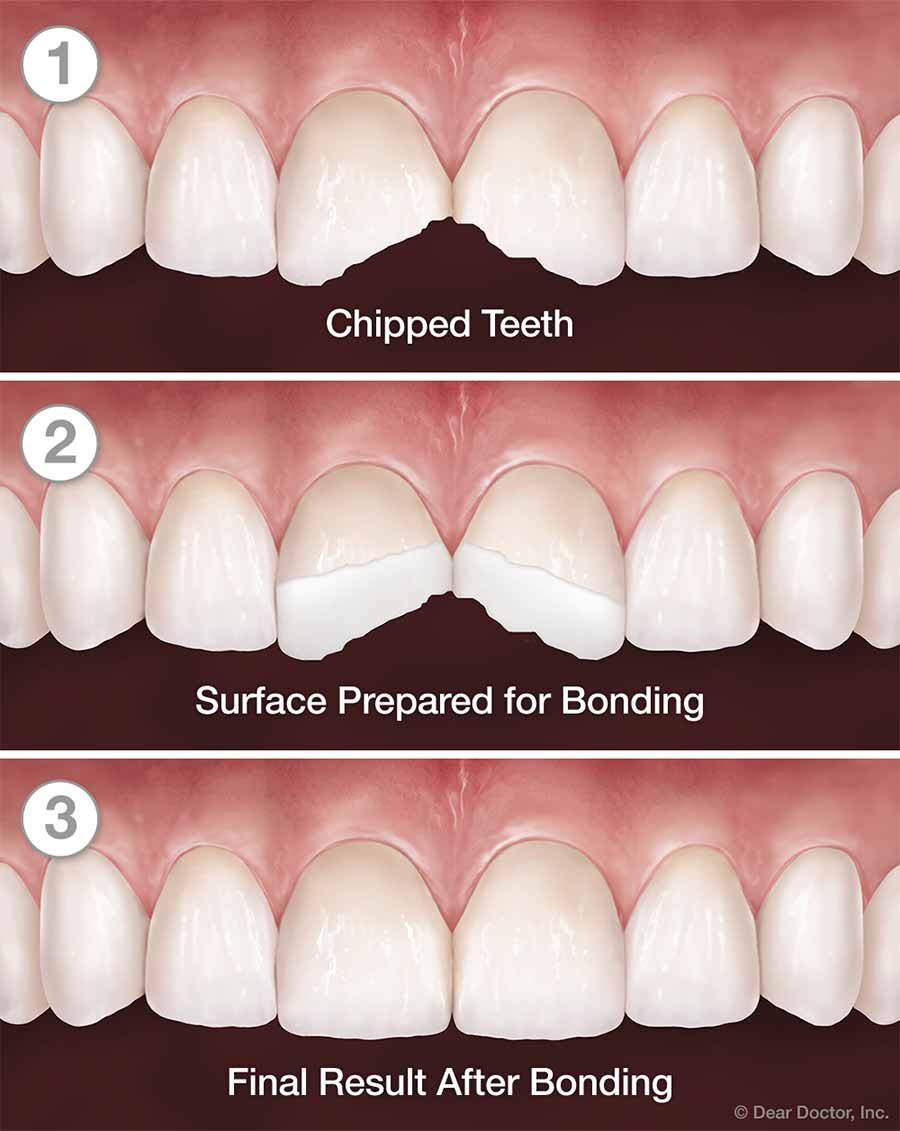 Composite Bonding | Panoramic Dental | Walnut Creek California