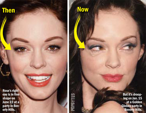 Plastic Surgery Gone Bad. the result of bad surgery