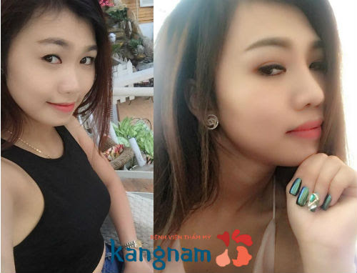 Bị viêm gan B có nên nâng mũi không 5