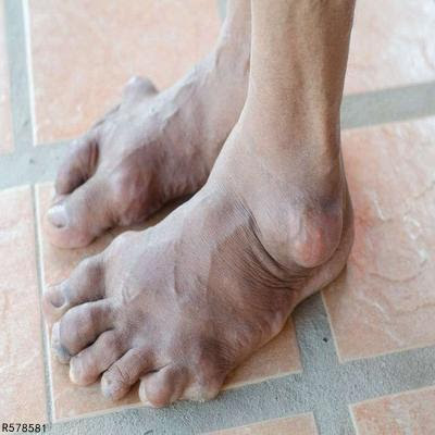 吃什么能消除痛风石 疾病 快速问医生 有问必答