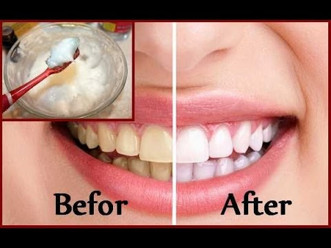 Teeth Whitening: Tooth Bleaching Fast Facts