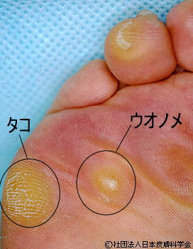 ウオノメ タコclavus Tylosis