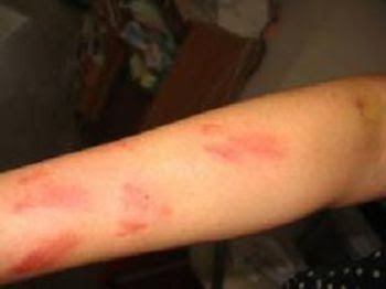 身近な危険生物 やけど虫編 Wiki Safety