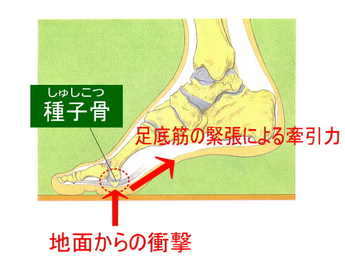 足の親指の裏の痛み 種子骨障害 よくある症状 疾患 札幌スポーツクリニック 札幌市中央区の整形外科 内科 リハビリ科