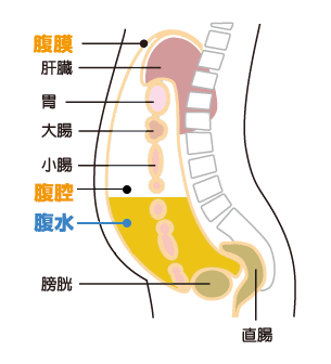 腹水って何ですか 難治性腹水症に対する腹水濾過濃縮再静注法cart