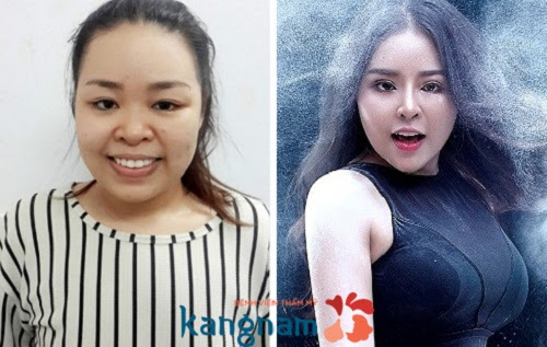 Nâng mũi có để lại hậu quả 4