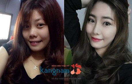 cách làm mũi cao bằng chất làm đầy?777