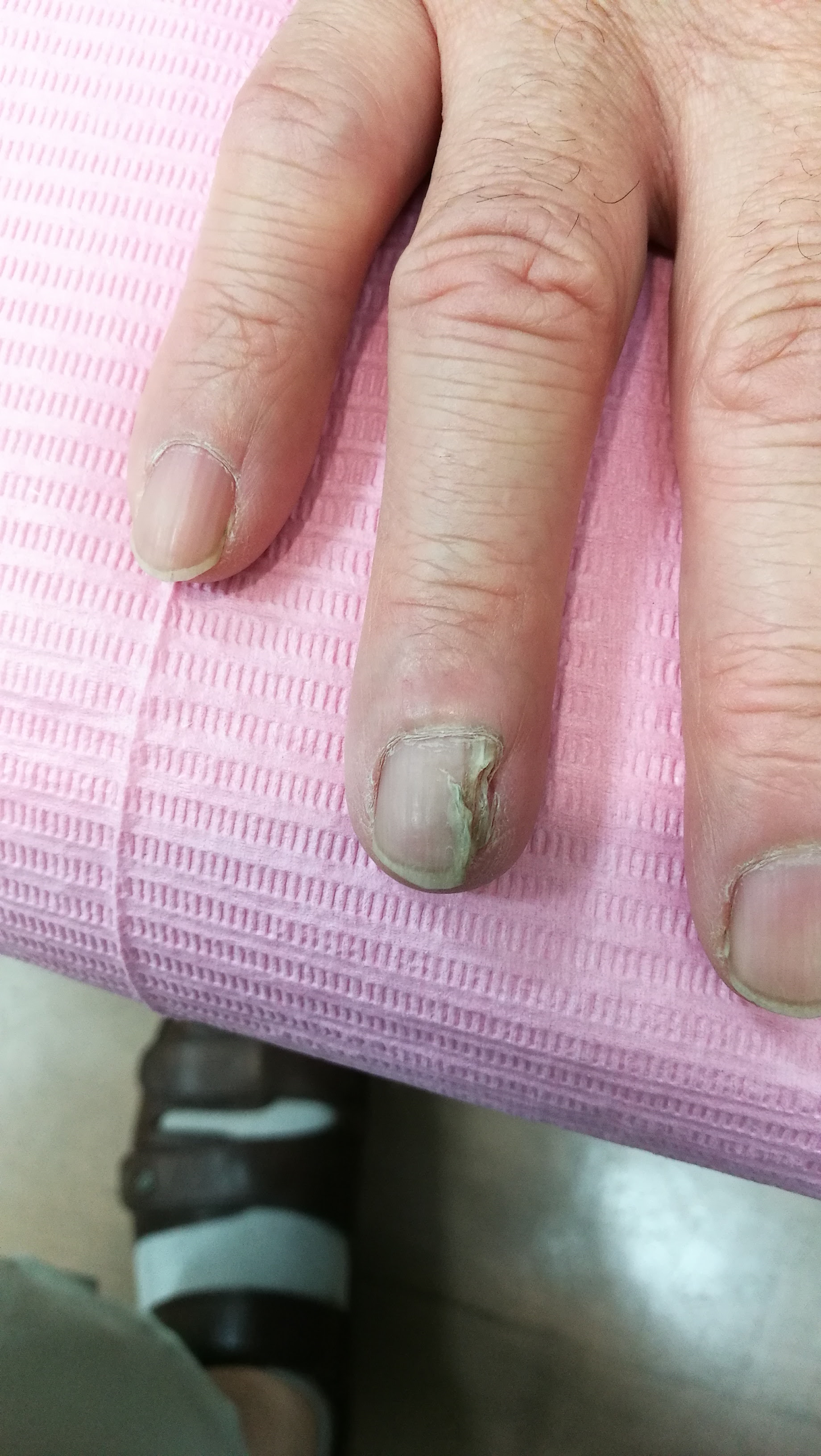 手の爪の変形にﾚｰｻﾞｰ治療が奏効した事例 二条駅前 なかみち皮膚科クリニック