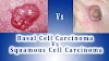 Skin Cancer Metastasis Sites : Hemangiosarcoma in Dogs - Flint Animal Cancer Center / Learn about the symptoms of metastatic breast cancer, the different types of re.