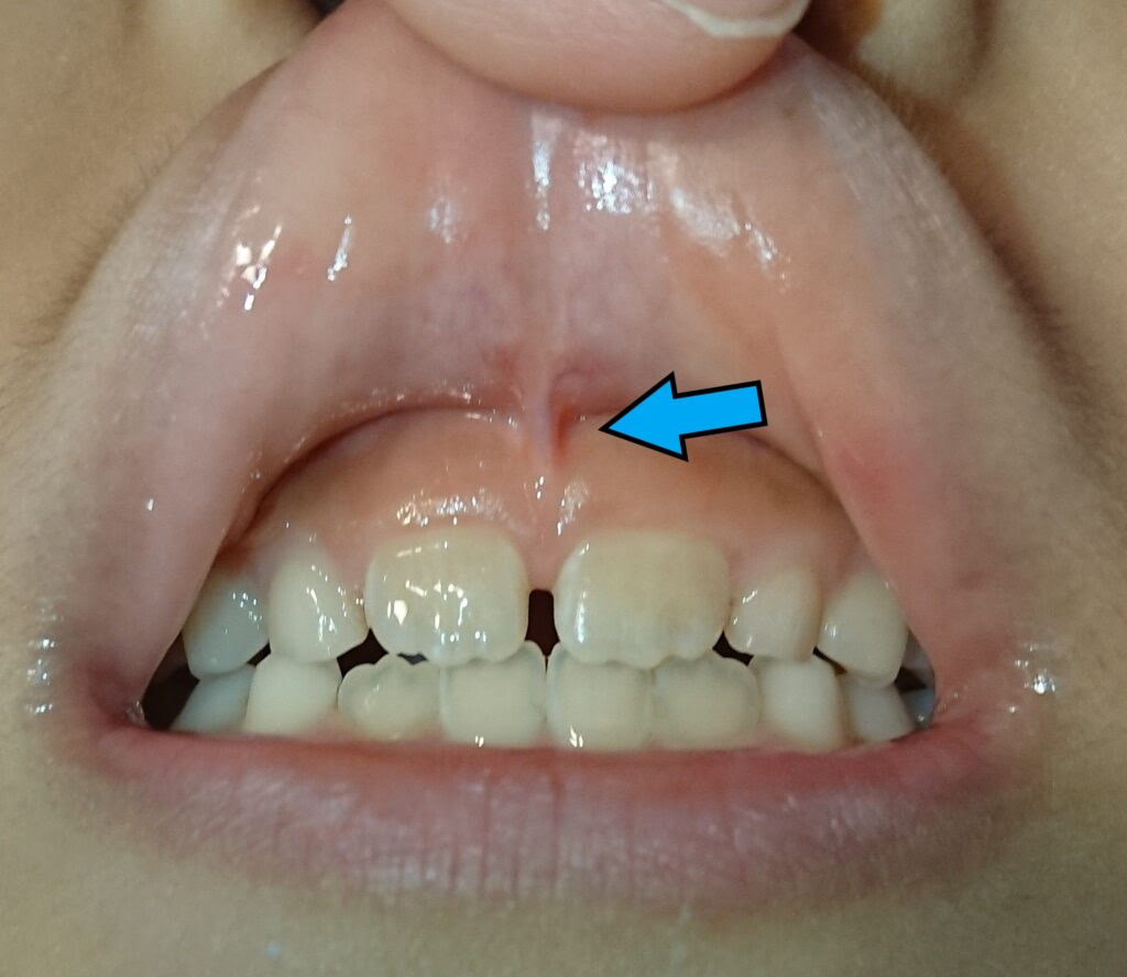 上唇小帯 じょうしんしょうたい ってなに 明石市大久保町の歯医者 あかね歯科クリニック 小児歯科