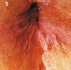 Hautarzt Dr Schnicke Publikationen Haemorrhoiden