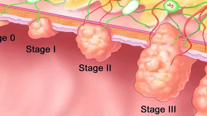 Stage Four Colon Cancer Stages 4 Photos : Colonoscopy Bowel Prep: What a Bad one Looks Like - YouTube / The pancreas is located behind the stomach, so having pancreatic cancer doesn't involve a palpable mass that you can feel.