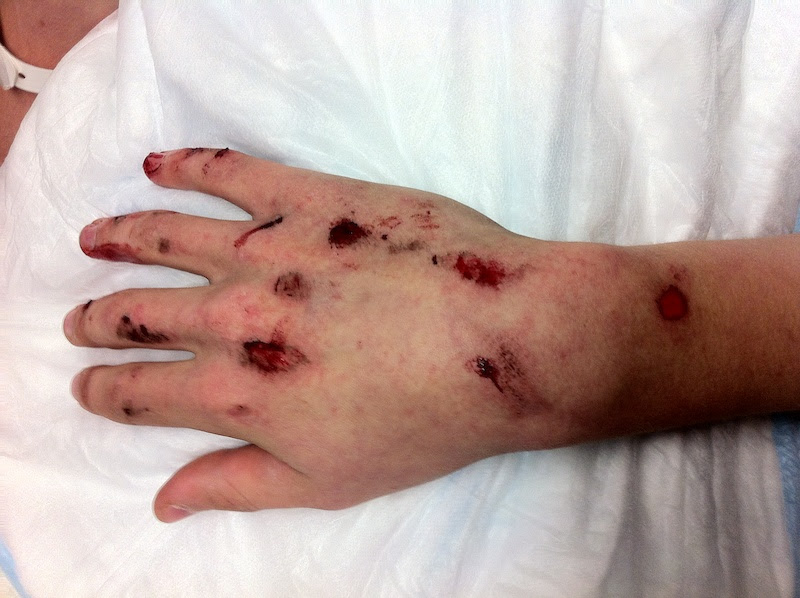 Should have had gloves on