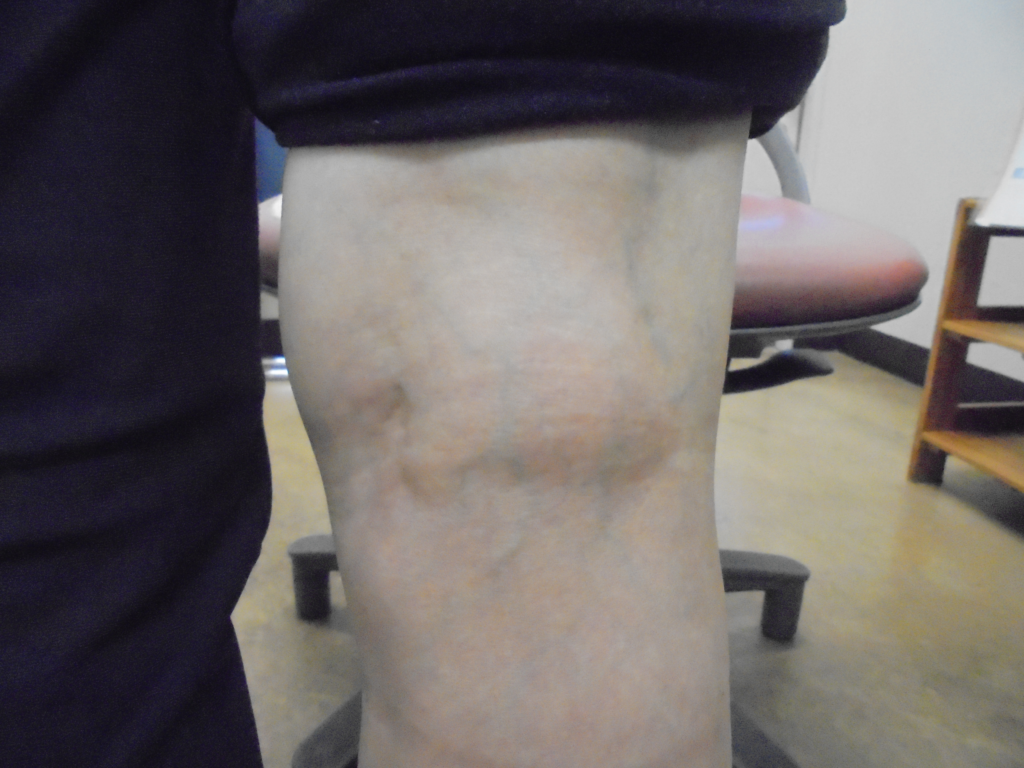 ベーカー嚢胞 Baker S Cyst 医學事始 いがくことはじめ