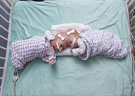 Des Bebes Siamois Subissent Une Separation Chirurgicale Et Les Parents Louent Jesus Christ Pour Son Intervention Ichretien Com