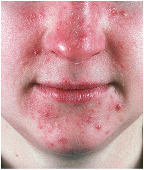 Acne Conglobata Wikipedia