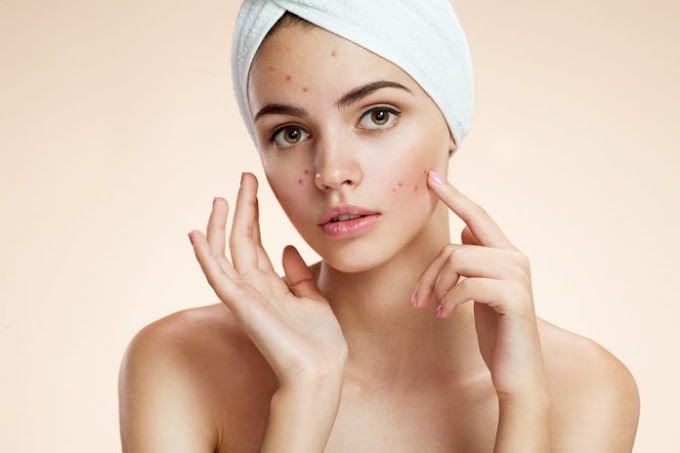 Rosacea: Penyebab, Gejala, Pengobatan, dan Pencegahan