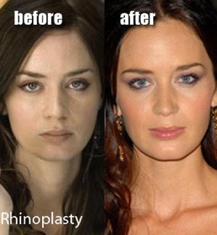 Celebrity Emily Blunt Plastic Surgery 2013 