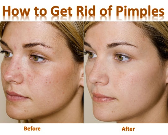 How to Get Rid of Pimples