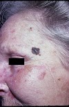 Warning Signs Skin Cancer Types : Skin cancer symptom: Melanoma sign could be dark stripe on : You probably know someone who gets a little sniffle or stomach ache, and before they can get to a doctor, they automatically assume the very worst: