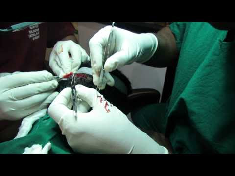 Advantages of FUE Hair Transplant