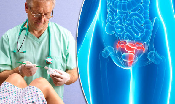 Cervical cancer symptoms: Woman said abnormal bleeding was ...